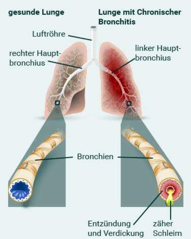 Krooninen keuhkoputkentulehdus