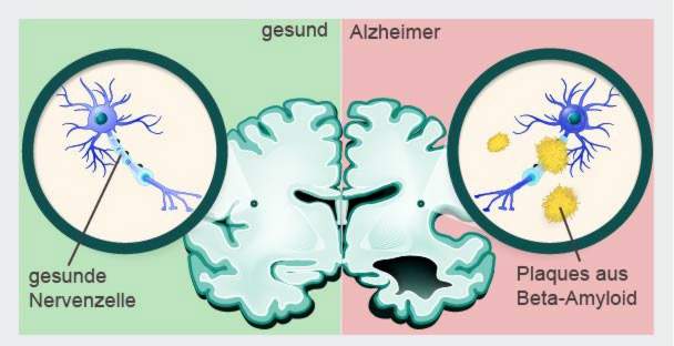 Alzheimerio nervų ląstelės