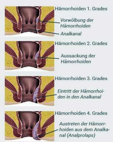 Hemoroidinės stadijos