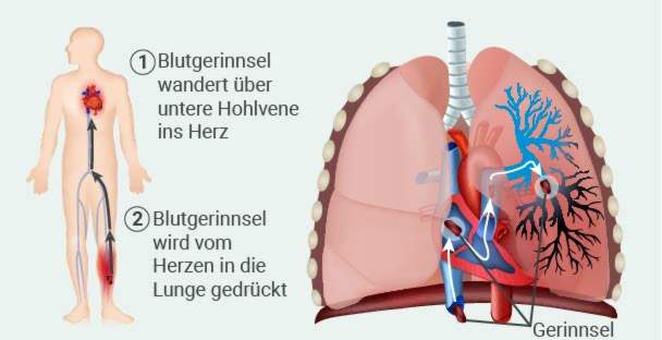 plaučių embolija