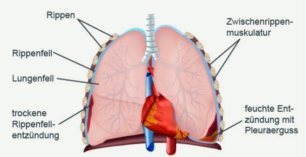 keuhkopussintulehdus