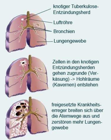 Progressiv lungetuberkulose