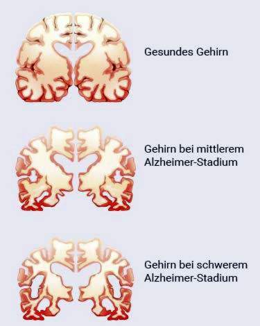 Gehirn bei Alzheimer