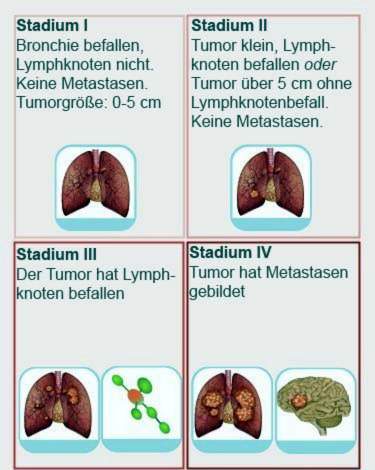 Lungenkrebs-Stadien