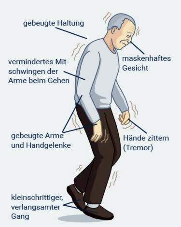 Symptome Parkinson