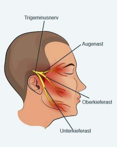 trigeminusneuralgi