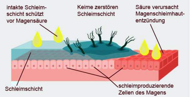 Maag-slijmvliesontsteking door bacteriën