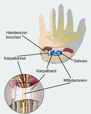 Karpaltunnelsyndrom anatomi
