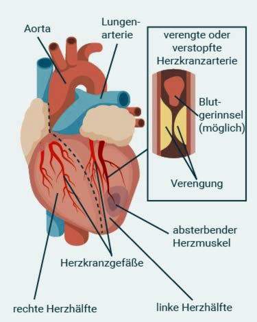 Herzinfarkt-Anatomie