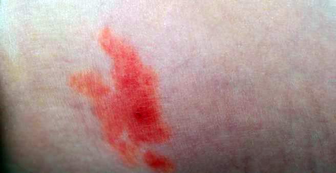 Insect bite: inflammation