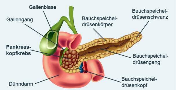 Eksokrin pancreaskræft