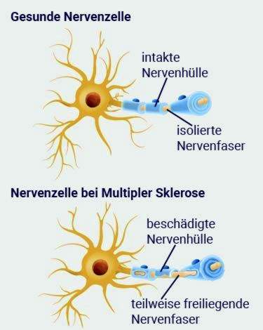 Nervenzellen bei MS