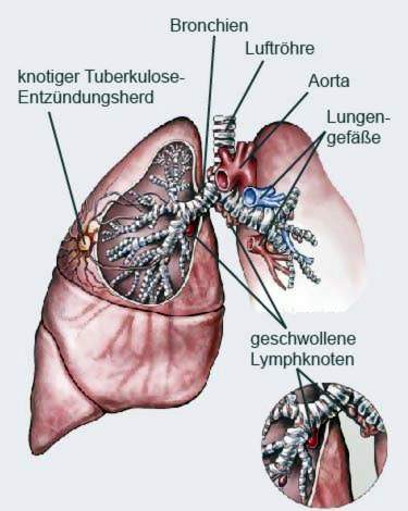 threat Yellowish Ru Tuberkuliozė (TB): infekcija, simptomai, terapija