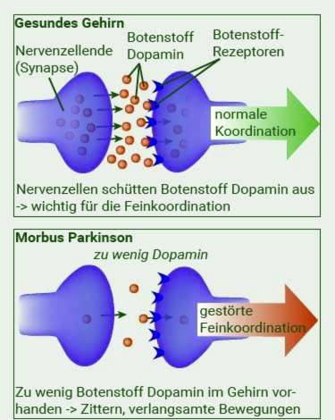 Dopaminmangel bei Parkinson