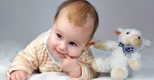 Baby with sborrhoeic dermatitis