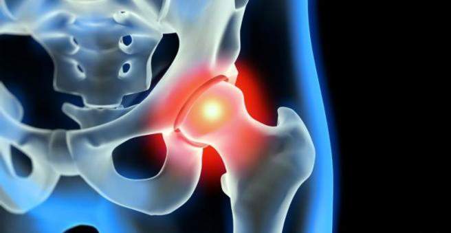 Impingement syndrome: hip