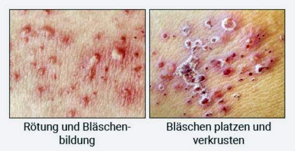 Different stages of shingles