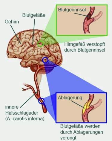 hipertenzija ir smegenų edema