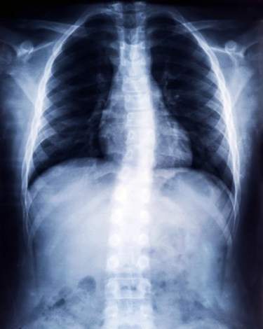 Röntgenaufnahme Skoliose