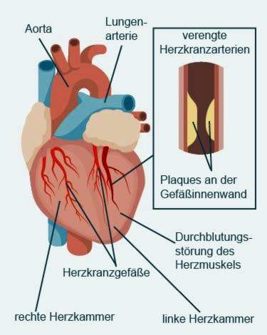 krūtinės anginos ir hipertenzijos pratimai