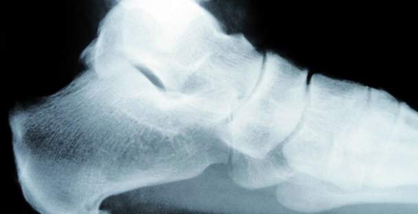 X-ray image of heel spur