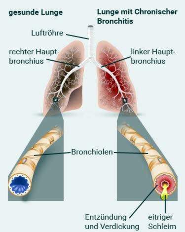 obstrukcinis bronchitas ir hipertenzija