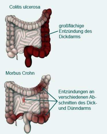 Colitis ulcerosa en de ziekte van Crohn